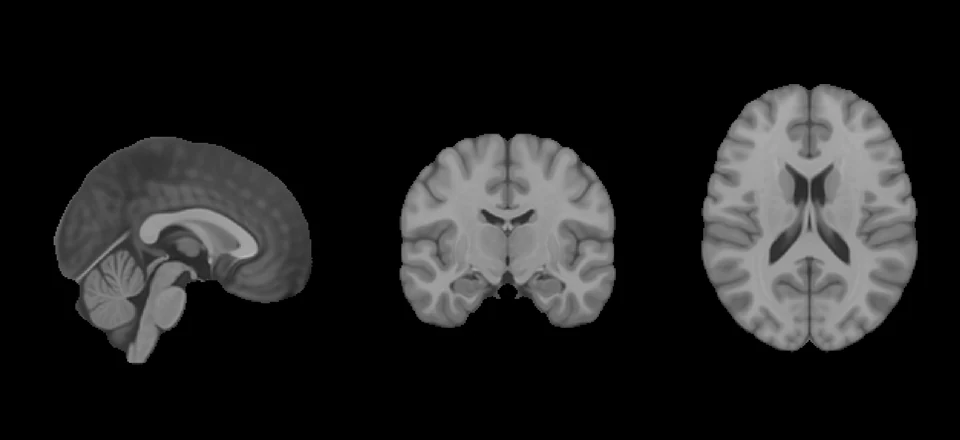 MNI referans anatomisinin kesitleri. Bir hastanın görüntüsü değildir ve EEG’den üretilmemiştir.